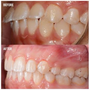 Hình ảnh niềng răng mắc cài của BN 15 tuổi – Nha khoa Peace Dentistry  - Ca 19
