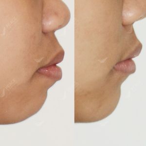 Hình ảnh niềng răng mắc cài của BN 15 tuổi – Nha khoa Peace Dentistry  - Ca 19