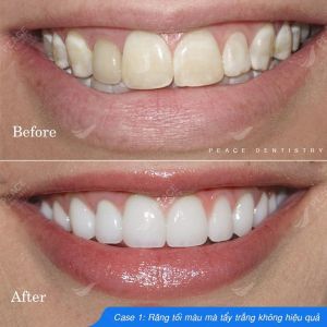 Hình ảnh dán sứ Veneer – Nha khoa Peace Dentistry  - Ca 2