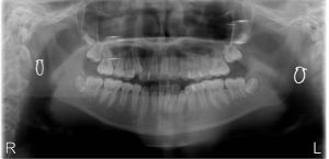 Hình ảnh niềng răng mắc cài cho bé 14 tuổi – Nha khoa Peace Dentistry – Ca 20