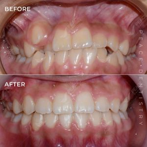 Hình ảnh niềng răng mắc cài cho bé 14 tuổi – Nha khoa Peace Dentistry – Ca 20