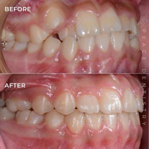 Hình ảnh niềng răng mắc cài cho bé 14 tuổi – Nha khoa Peace Dentistry – Ca 20