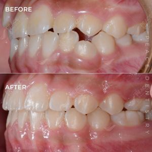 Hình ảnh niềng răng mắc cài cho bé 14 tuổi – Nha khoa Peace Dentistry – Ca 20