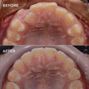 Hình ảnh niềng răng mắc cài cho bé 14 tuổi – Nha khoa Peace Dentistry – Ca 20