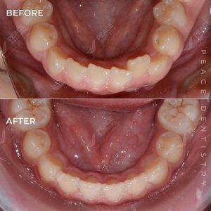 Hình ảnh niềng răng mắc cài cho bé 14 tuổi – Nha khoa Peace Dentistry – Ca 20