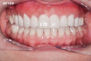 Hình ảnh bọc răng sứ và cắt lợi – Nha khoa Peace Dentistry – ca 21