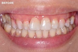 Hình ảnh bọc răng sứ và cắt lợi – Nha khoa Peace Dentistry – ca 21