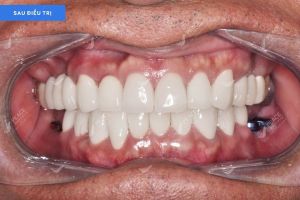Hình ảnh bọc răng sứ và trồng răng implant – Nha khoa Peace Dentistry – Ca 22