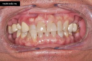 Hình ảnh bọc răng sứ và trồng răng implant – Nha khoa Peace Dentistry – Ca 22