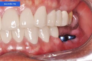 Hình ảnh bọc răng sứ và trồng răng implant – Nha khoa Peace Dentistry – Ca 22