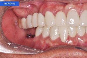 Hình ảnh bọc răng sứ và trồng răng implant – Nha khoa Peace Dentistry – Ca 22