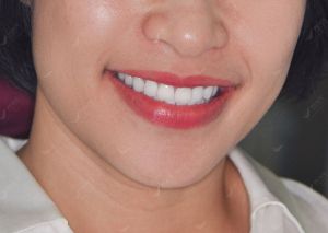 Hình ảnh dán sứ Veneer – Nha khoa Peace Dentistry – Ca 23