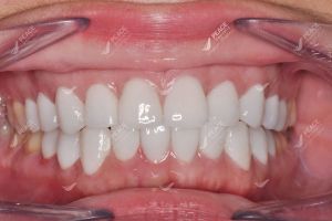 Hình ảnh dán sứ Veneer – Nha khoa Peace Dentistry – Ca 23