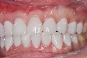 Hình ảnh dán sứ Veneer – Nha khoa Peace Dentistry – Ca 23