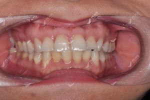 Hình ảnh dán sứ Veneer – Nha khoa Peace Dentistry – Ca 23