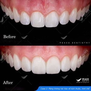 Hình ảnh dán sứ Veneer – Nha khoa Peace Dentistry - Ca 3