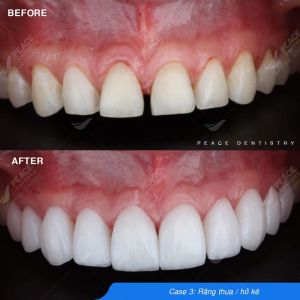 Hình ảnh dán sứ Veneer – Nha khoa Peace Dentistry  - Ca 4