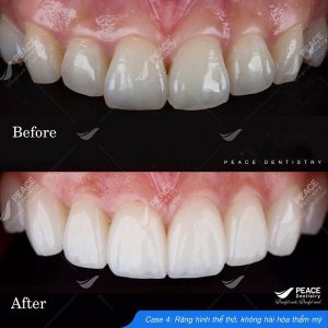 Hình ảnh dán sứ Veneer – Nha khoa Peace Dentistry - Ca 5