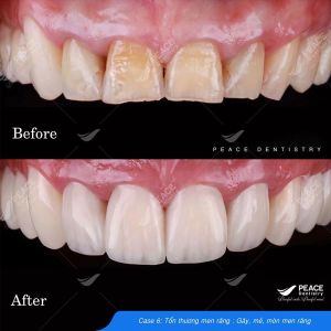 Hình ảnh dán sứ Veneer – Nha khoa Peace Dentistry - Ca 6