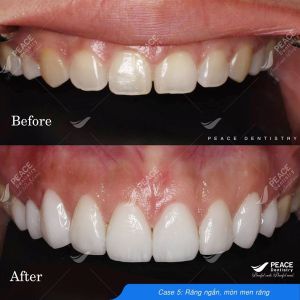 Hình ảnh dán sứ Veneer – Nha khoa Peace Dentistry - Ca 7