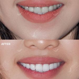 Hình ảnh bọc răng sứ - Nha khoa Peace Dentistry - Ca 8
