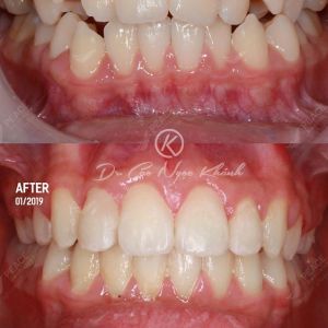 Hình ảnh niềng răng mắc cài tự buộc – Nha khoa Peace Dentistry  - Ca 9