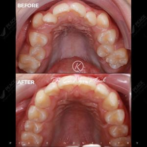 Hình ảnh niềng răng mắc cài tự buộc – Nha khoa Peace Dentistry  - Ca 9