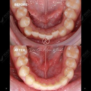 Hình ảnh niềng răng mắc cài tự buộc – Nha khoa Peace Dentistry  - Ca 9