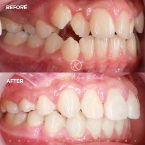 Hình ảnh niềng răng mắc cài tự buộc – Nha khoa Peace Dentistry  - Ca 9