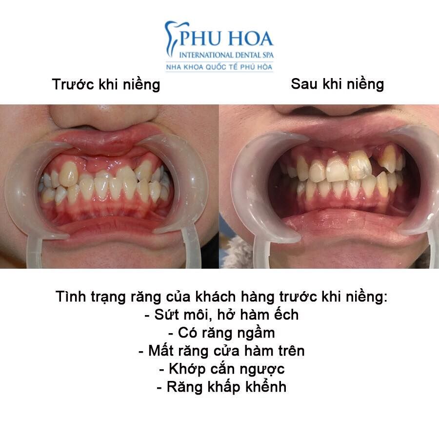 Hình ảnh niềng răng Nha khoa Quốc tế Phú Hòa – Ca 1