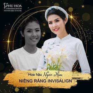 Hình ảnh niềng răng Invisalign của Hoa Hậu Ngọc Hân Nha khoa Quốc tế Phú Hòa – Ca 11