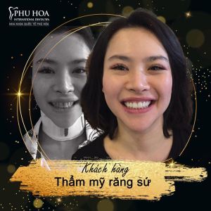 Hình ảnh bọc răng sứ Nha khoa Quốc tế Phú Hòa – Ca 12