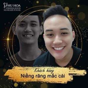 Hình ảnh niềng răng mắc cài Nha khoa Quốc tế Phú Hòa – Ca 13