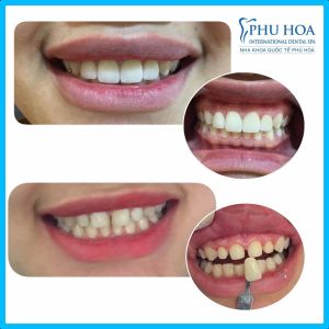 Hình ảnh dán sứ Veneer Nha khoa Quốc tế Phú Hòa – Ca 15