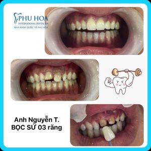 Hình ảnh bọc răng sứ Nha khoa Quốc tế Phú Hòa – Ca 16