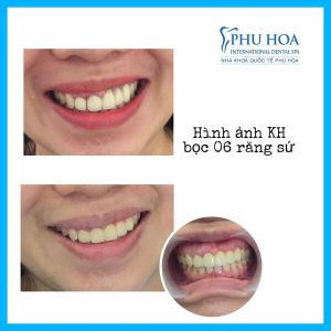 Hình ảnh bọc răng sứ Nha khoa Quốc tế Phú Hòa – Ca 17