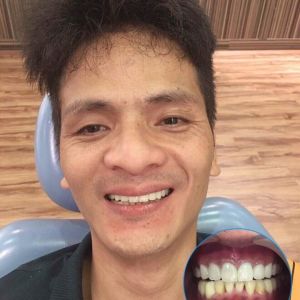Hình ảnh bọc răng sứ Nha khoa Quốc tế Phú Hòa – Ca 18