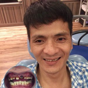 Hình ảnh bọc răng sứ Nha khoa Quốc tế Phú Hòa – Ca 18