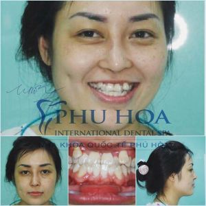 Hình ảnh niềng răng của chị Hương Nha khoa Quốc tế Phú Hòa – Ca 19