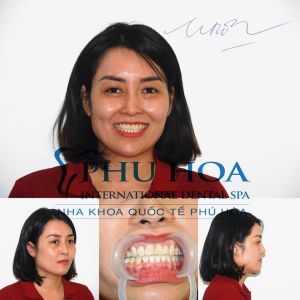 Hình ảnh niềng răng của chị Hương Nha khoa Quốc tế Phú Hòa – Ca 19