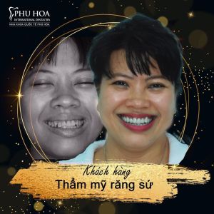 Hình ảnh bọc răng sứ Nha khoa Quốc tế Phú Hòa - Ca 2