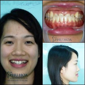 Hình ảnh niềng răng Nha khoa Quốc tế Phú Hòa – Ca 20