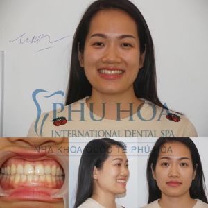 Hình ảnh niềng răng Nha khoa Quốc tế Phú Hòa – Ca 20