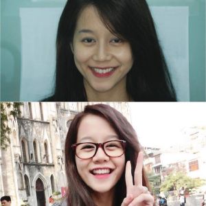 Hình ảnh bọc răng sứ của An Nguy - Nha khoa Quốc tế Phú Hòa – Ca 21