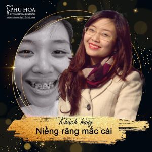 Hình ảnh niềng răng mắc cài Nha khoa Quốc tế Phú Hòa – Ca 5