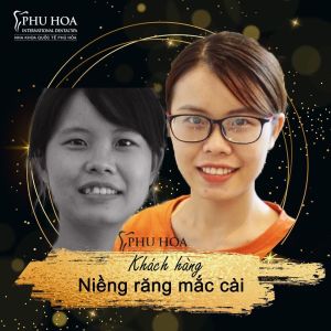 Hình ảnh niềng răng mắc cài Nha khoa Quốc tế Phú Hòa – Ca 9