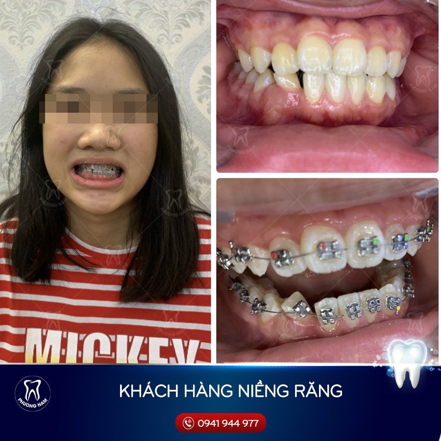 Hình ảnh Niềng răng: Hình ảnh niềng răng của cháu Mi Hương (Hà ...