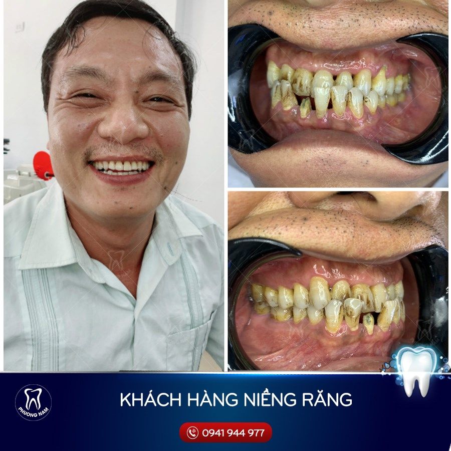 Hình ảnh Niềng răng: Hình ảnh niềng răng của một KH nam 41 tuổi ...