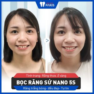 Hình ảnh bọc răng sứ nano 5S của KH Phạm Chinh – Ca 10