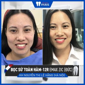 Hình ảnh bọc răng sứ của KH Nguyễn Thị Lệ Hằng – Ca 102
